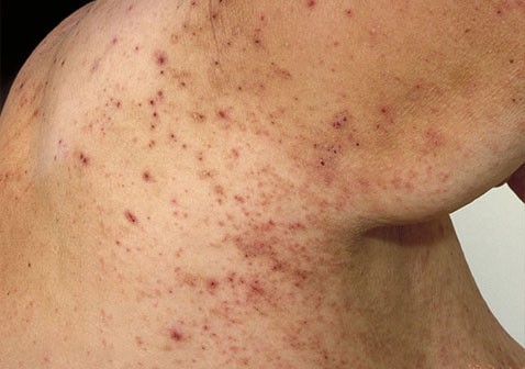 肩膀上有螨虫的图片