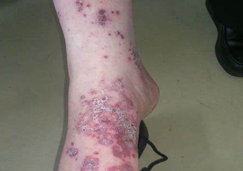 脚疱疹性湿疹的症状图片3