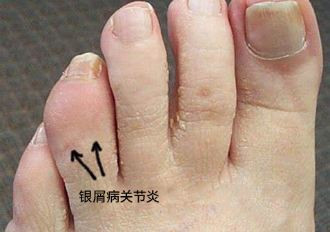 脚趾银屑病关节炎图片