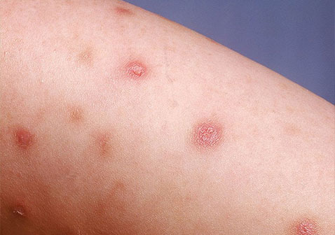 结节性痒疹初期症状图片2