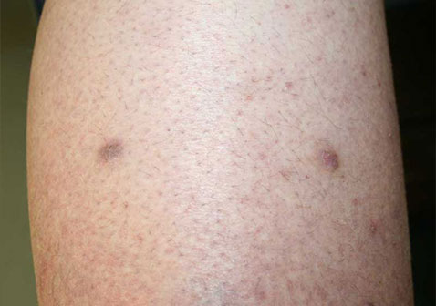 结节性痒疹初期症状图片