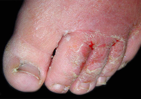 浸渍糜烂型脚趾真菌感染图片