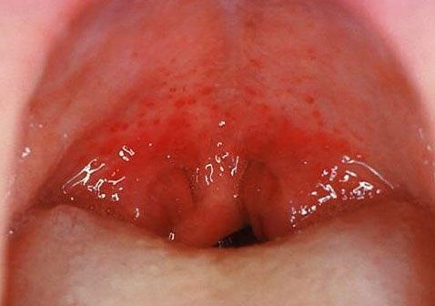 口腔淋病的早期症状图片