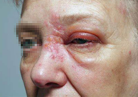 脸上带状疱疹图片