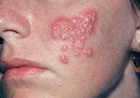 脸上单纯疱疹图片