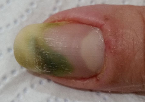 绿甲综合症图片