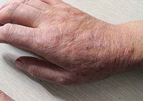 慢性湿疹阶段图片