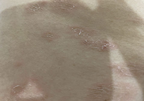 玫瑰糠疹后期蜕皮图片