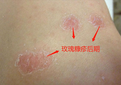 玫瑰糠疹后期蜕皮图