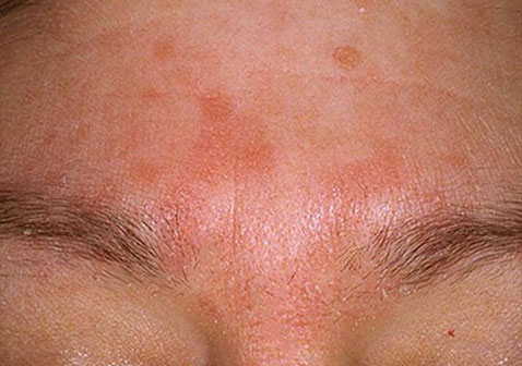 眉毛脂溢性皮炎初期图片