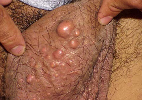 男性阴囊囊肿图片