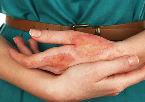 乳胶过敏症状图片2