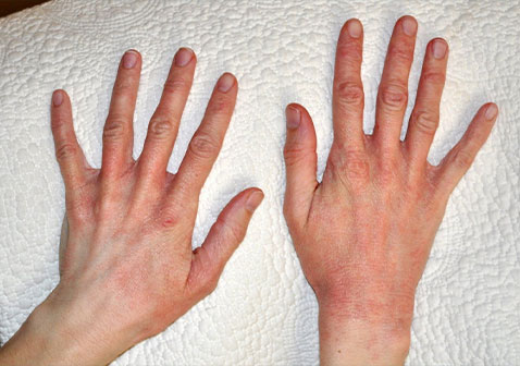 乳胶过敏症状图片3