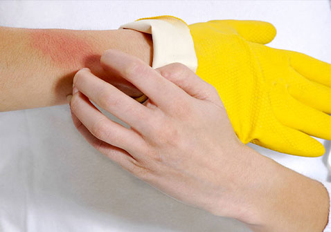 乳胶过敏症状图片