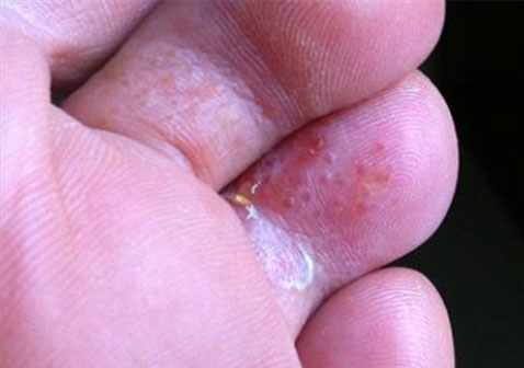 水疱型脚趾真菌感染图片