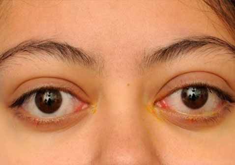 突眼症症状图片