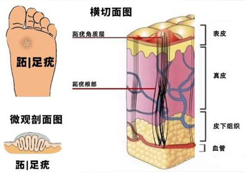 跖疣横截面内部结构图