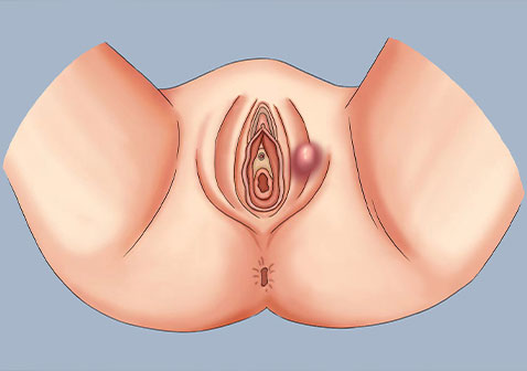 阴部疖肿的硬包图片