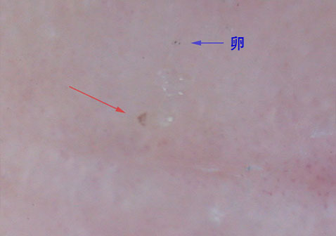 显微镜下肩膀上有螨虫的图片