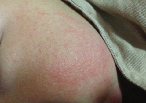 亚急性湿疹阶段图片