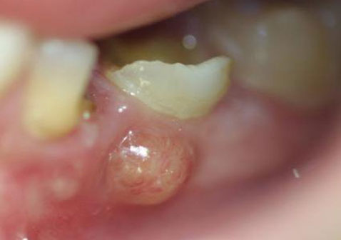 牙周脓肿图片