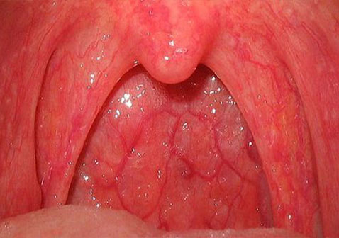 咽部淋病图片