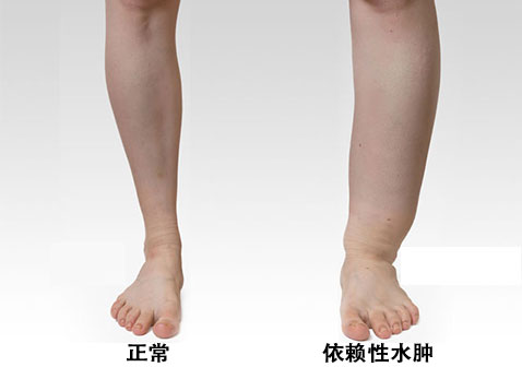 小腿水肿真实照片