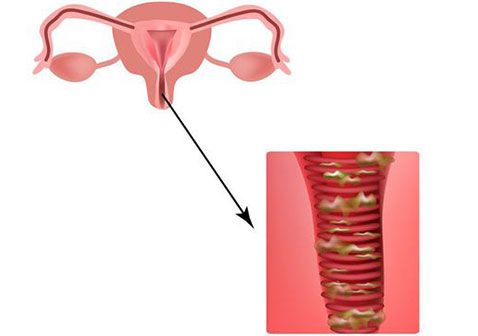 阴道炎图片
