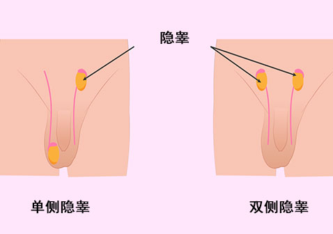 隐睾症图片