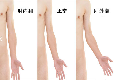 肘外翻图片