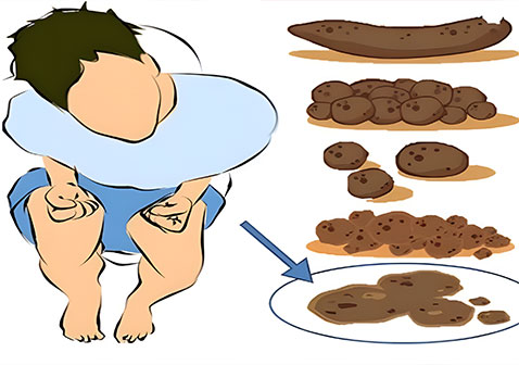 大便不成形图片
