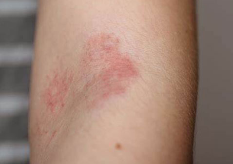湿疹图片