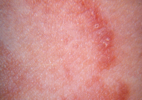 女性股癣症状图片