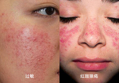 过敏和红斑狼疮对照图片