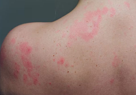 后背过敏性皮炎图片