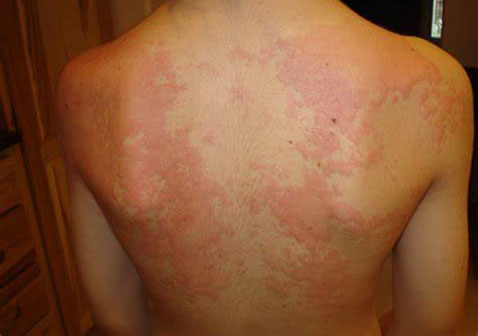 后背过敏性皮炎图片