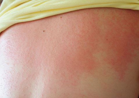 过敏性皮肤病图片