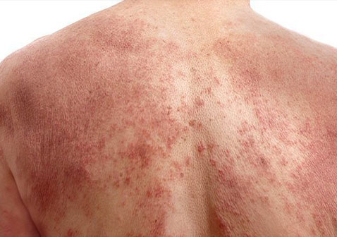 后背过敏性皮炎图片