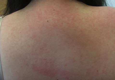 后背过敏性皮炎图片