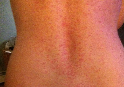 女性后背过敏性皮炎湿疹图片
