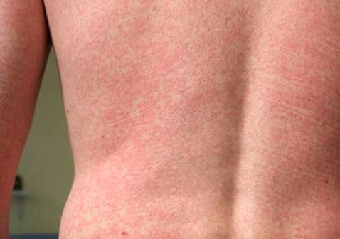 后背过敏性皮炎图片