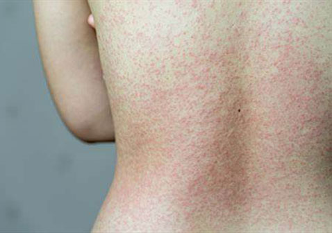 后背过敏性皮炎图片