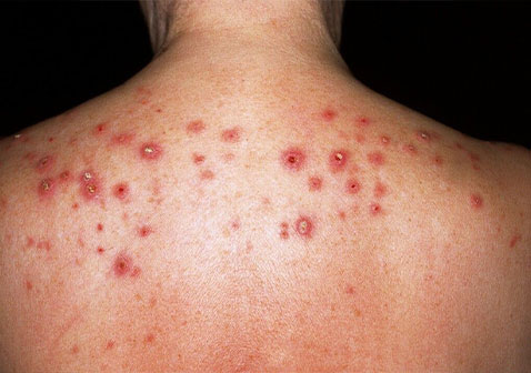 结节性痒疹图片