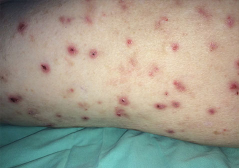 结节性痒疹图片