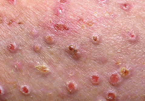 结节性痒疹图片