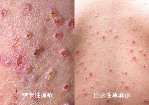 结节性痒疹和丘疹性荨麻疹的区别图片