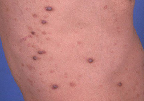 结节性痒疹图片