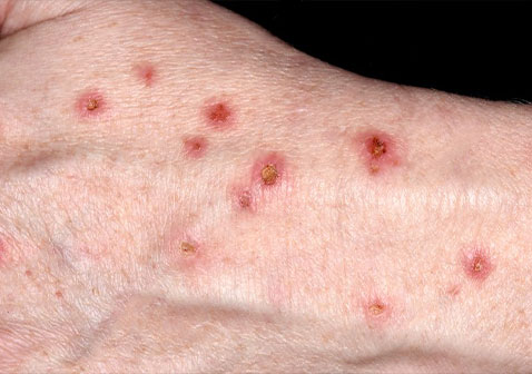 结节性痒疹图片