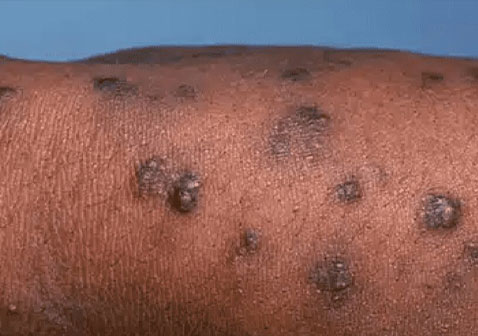 结节性痒疹晚期图片