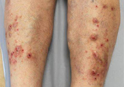 结节性痒疹图片